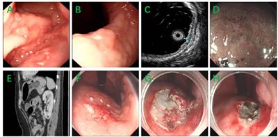 Gastric Mucosa-Associated Lymphoid Tissue Lymphomas Diagnosed by Jumbo Biopsy Using Endoscopic Submucosal Dissection: A Case Report
